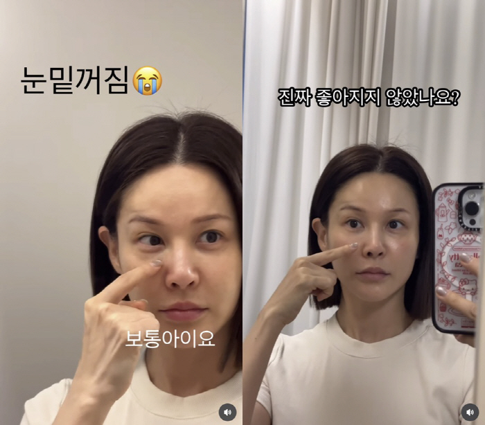 '43세' 아이비, 눈밑꺼짐 어쩌나 했더니..시술 후 확 달라진 얼굴 '깜짝'