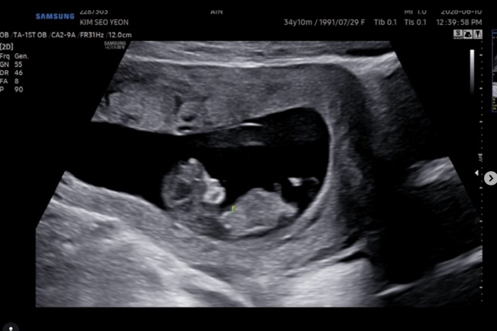 Robin and Song Ha-ra Expecting a Baby After Miscarriage Heartache: "We Named the Baby Cannes, and It Even Endured Our Trip to France" [Official]