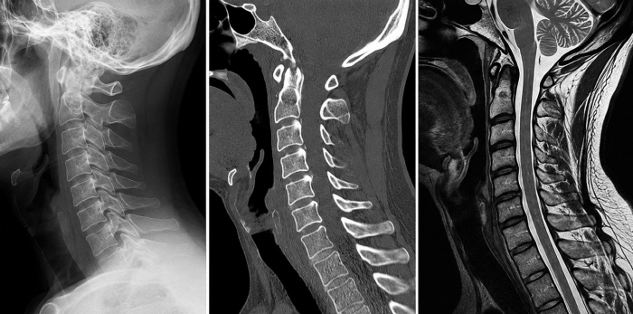 ◇X-ray, CT, and MRI images of the side of a patient's neck, from left. AI-generated image