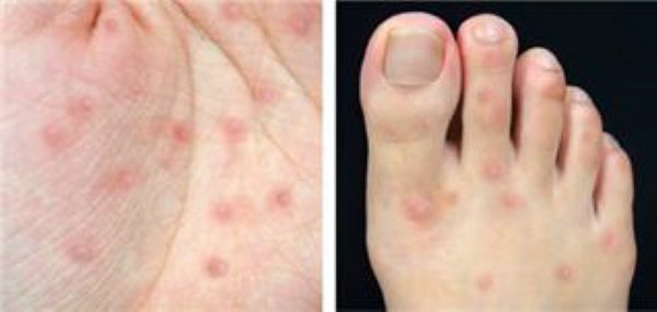 Blisters on a Child’s Hands, Feet and Mouth What Is the Summer Outbreak of Hand, Foot and Mouth Disease, and How Is It Different from Chickenpox?