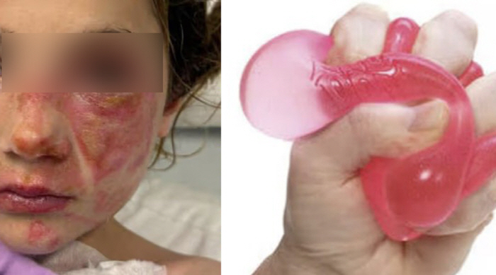 'Toy Explosions Leave Children with Skin Burned Off'... Burn Injuries Rise as Social Media Trend Spreads