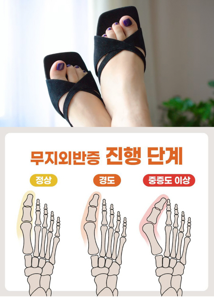 Sandals can trigger a sharp pain Summer bunions require caution. How can you check yourself?