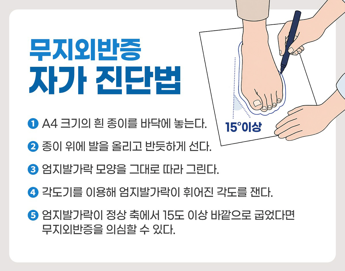 샌들 신었다가 '찌릿', 여름철 무지외반증 주의…자가진단법은?