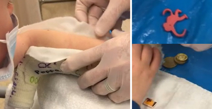 The unexpected surprise inside a 4-year-old's cast left mom and doctor stunned
