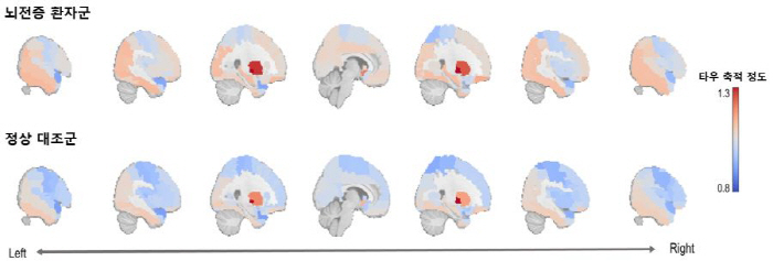 In epilepsy patients without dementia, researchers find increased neurodegeneration-related substances in the brain, linking it to systemic aging