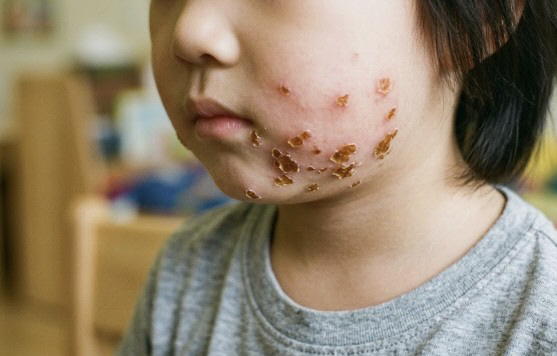 Crusts on a Child's Skin? What Is Impetigo?