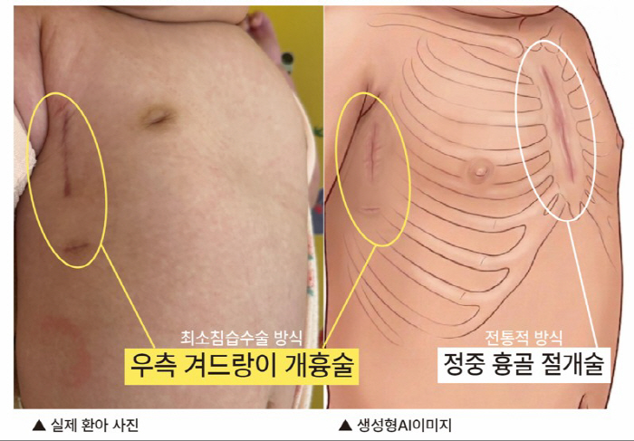 Heart Surgery Without a Chest Scar?