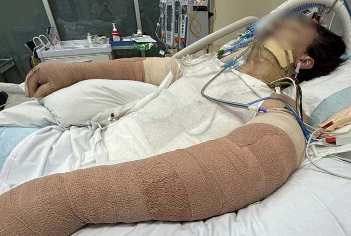 Robot Vacuum Explodes While Charging, Fire Suspected... Man in His 20s Suffers Burns Over 75% of His Body, in Critical Condition