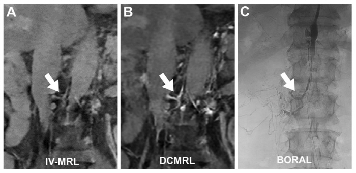 MRI Technique Developed to Identify Liver and Mesenteric Lymphatic Vessels Using Only an Intravenous Injection