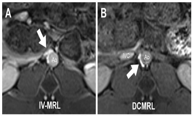Comparison of IV-MRL and DCMRL images. Unlike DCMRL (B), IV-MRL (A) visualizes the liver and mesenteric lymphatic vessels.