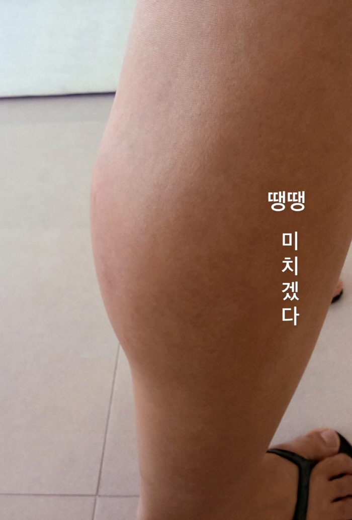 Jin Jae-young Goes Through It All... “My Leg Swelled Up After a Centipede Bite. Clear Bite Marks”