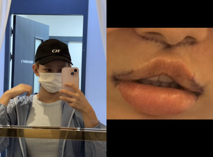 Maeng Seung-ji Undergoes Controversial Philtrum Reduction Surgery 'I Thought About It for Five Years, and I Finally Did It. I Was Worried About Scarring'