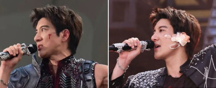 Famous Singer Falls During Concert, Stitches Face With 39 Stitches... 'I Forgot the Pain on Stage'