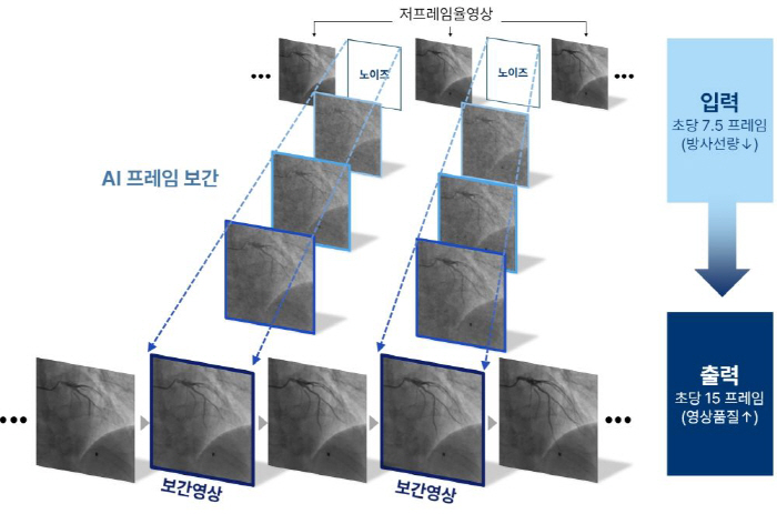 AI Model Developed to Cut Radiation Exposure in Coronary Angiography by More Than Half