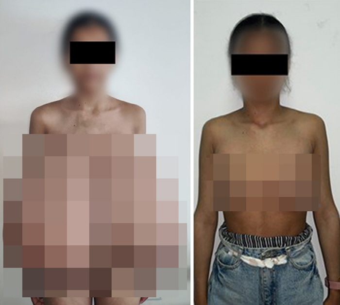 "가슴이 체중의 4분의 1"…희귀질환 10대 소녀 17㎏ 제거