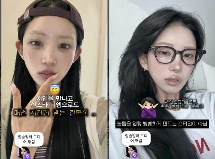 '故최진실 딸' 최준희, 입술 필러 또 맞았다 "18살부터 계속"