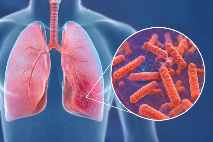 'Low Albumin Levels in Pulmonary TB Patients Raise ICU Transfer Risk 18-Fold'
