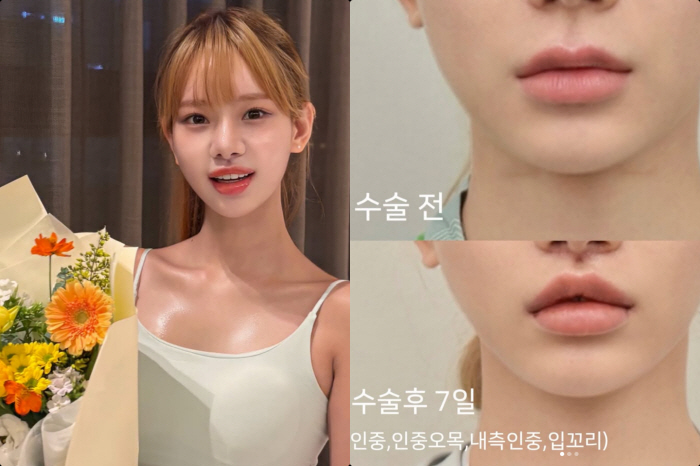 맹승지, 인중축소+입꼬리 성형 전후 비교.."인중 짧아져 더 어려보여" 만족