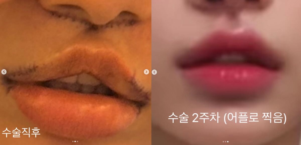 맹승지, 인중축소+입꼬리 성형 전후 비교.."인중 짧아져 더 어려보여" 만족