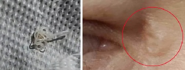 눈 주변 통증·가려움, 알고 보니 개·고양이 기생충 '꿈틀'