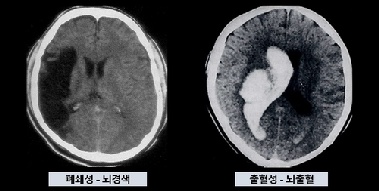 고령사회 역할 커지는 뇌졸중 전문병원…정부 정책 '엇박자'