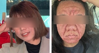 20대 여성 임신 후 여드름 '폭발'…“얼굴 울퉁불퉁, 60대처럼 변해”