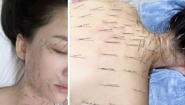 유명 배우 “동안 피부·몸매 비결은 침술”…얼굴부터 엉덩이까지 100개 이상 침 꽂아