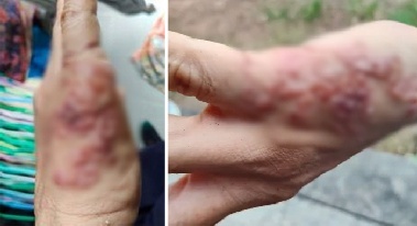 제초 작업 후 손 가렵고 '꿈틀꿈틀'…개·고양이 키운다면 '조심'