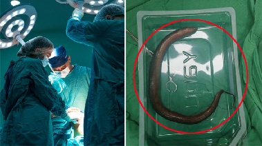 뱃속에서 살아 있는 30cm 장어 '꿈틀'…어쩌다 들어갔을까?