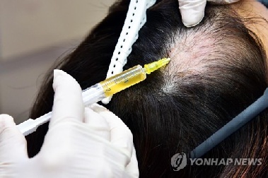 인하대병원 연구팀 “탈모 여성, 감정 영역 손상 두드러져”