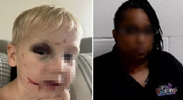 멍든 눈·깊게 팬 상처 “누가 아이에게 이런 짓을…” 가해자 보석 석방에 '분노'