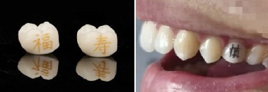中 MZ 세대 한 개당 20만원 '치아 문신' 유행…“깨질 수 있어” 우려