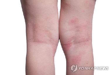 '내게 맞는 아토피 약' 찾기 어려운 이유