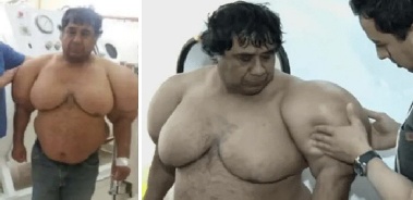 몸이 풍선처럼 부푼 남성, 12년간 고통…“살아 있는 게 기적”