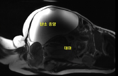10kg 난소 종양에 자궁외 임신까지…간 근처에서 자란 '기적의 아기' 출산