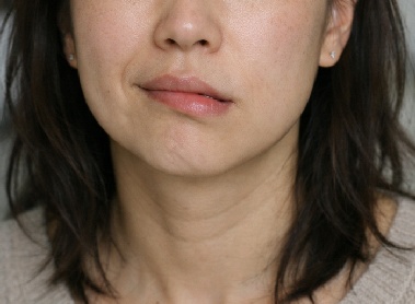 '비뚤어진' 얼굴 어쩌나?…안면신경마비 통합의료 '회복률' 83.3%