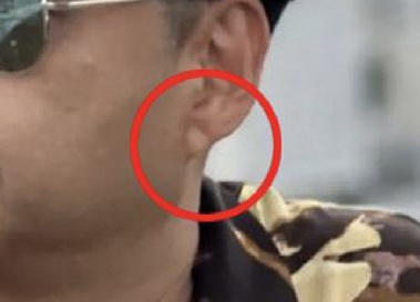 AI로 식별 '귓불 주름', 뇌소혈관 손상과연관성 규명…세계 최초 AI 모델 개발