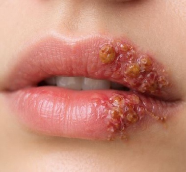 단순 입술 물집인 줄 알았는데, 30대 여성 뇌사 '충격'