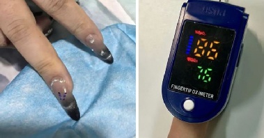 젤 네일 때문에 목숨 잃을 뻔…심장마비 치료 지연, 이유는?