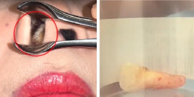 코 안에 왜 치아가 있지? …“거꾸로 자랐다”