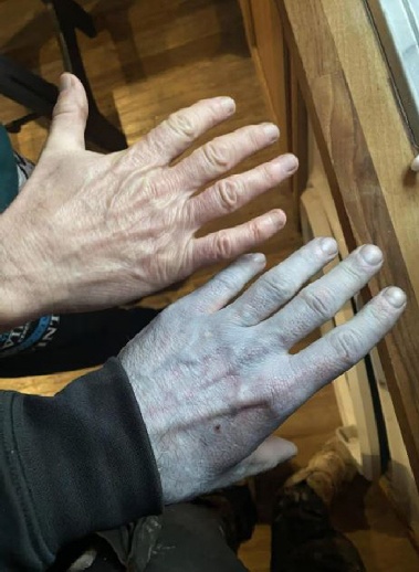 파란색으로 변한 손·얼굴, 긴급 이송…의료진 웃은 이유는?