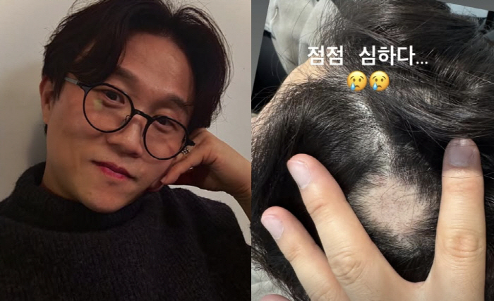 '이솔이♥' 박성광, 원형탈모 점점 더 커진 현상태...심각한 수준에 철렁 “심하다”