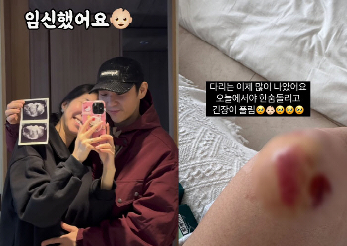 '쌍둥이 임신' 김지혜, 심각했던 낙상사고…“손가락 금가”