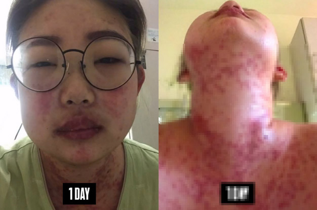 '55kg 감량' 최준희, 심각했던 루푸스 약물 부작용 “먹방 유튜버처럼 폭식, 얼굴 무너져”