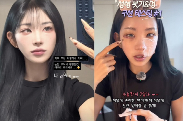 '최진실 딸' 최준희, 또 성형했다..붉게 멍든 눈 리얼 공개 “부기 덜 빠져”