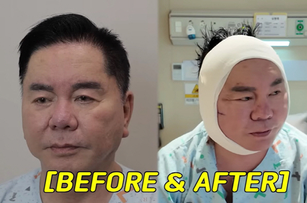 67세 심형래, 성형후 퉁퉁 부은 얼굴..안면거상 비포·애프터 공개