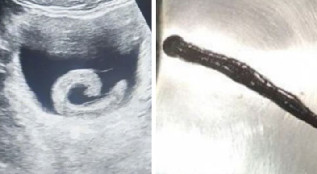 20대 남성 방광에 살아있는 거머리 '꿈틀'..이유가 황당