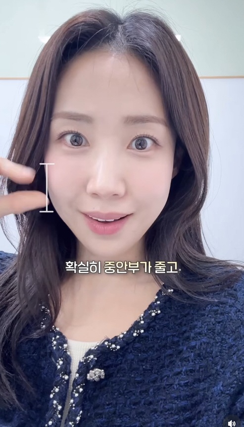 '여구여신' 최희, 중안부 축소 시술로 '확 달라진 얼굴'..“효과 대박”