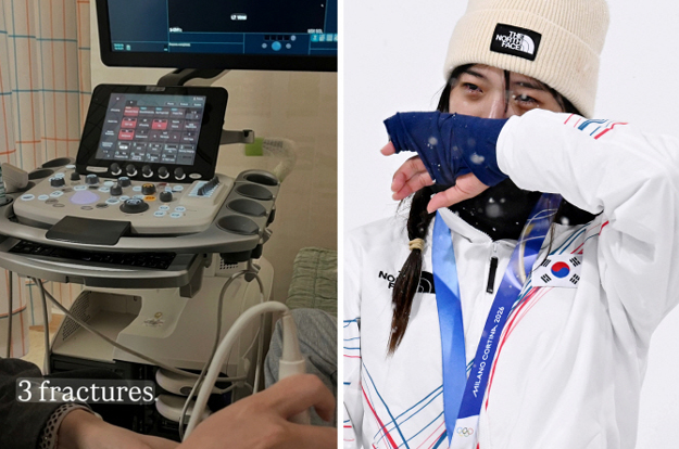 “얼마나 아팠을까” '불굴의 투혼 金' 최가온, 결국 세 군데 골절 진단