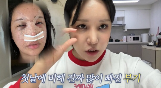 랄랄, 코 성형수술만 3번째 “이런 적은 처음...주변서도 놀라”